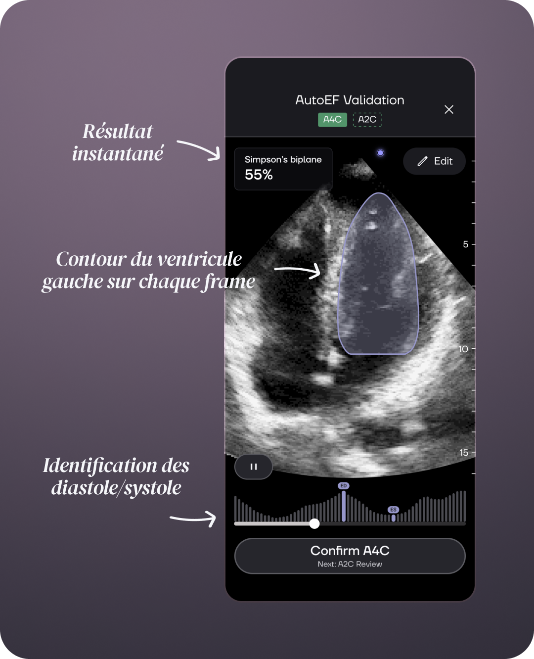 Interface AutoEF montrant le résultat instantané, le contour du ventricule gauche et l'identification de la diastole et de la systole